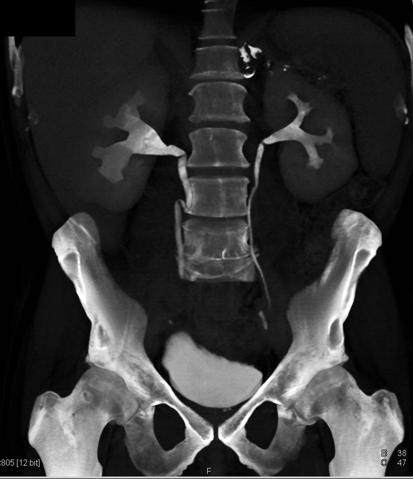 Bladder Cancer Without Obstruction - CTisus CT Scan