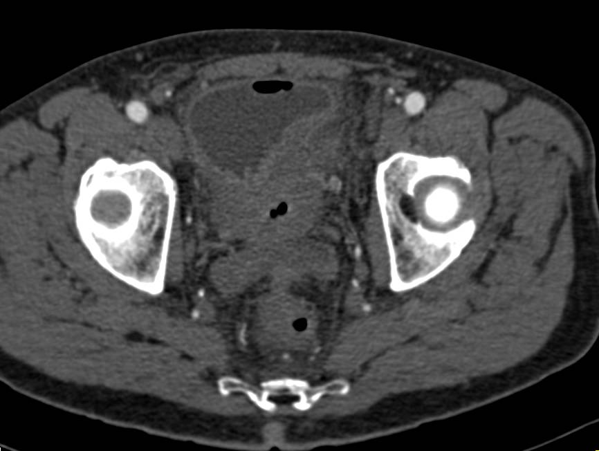 Transitional Cell Cancer (TCC) of the Bladder - CTisus CT Scan