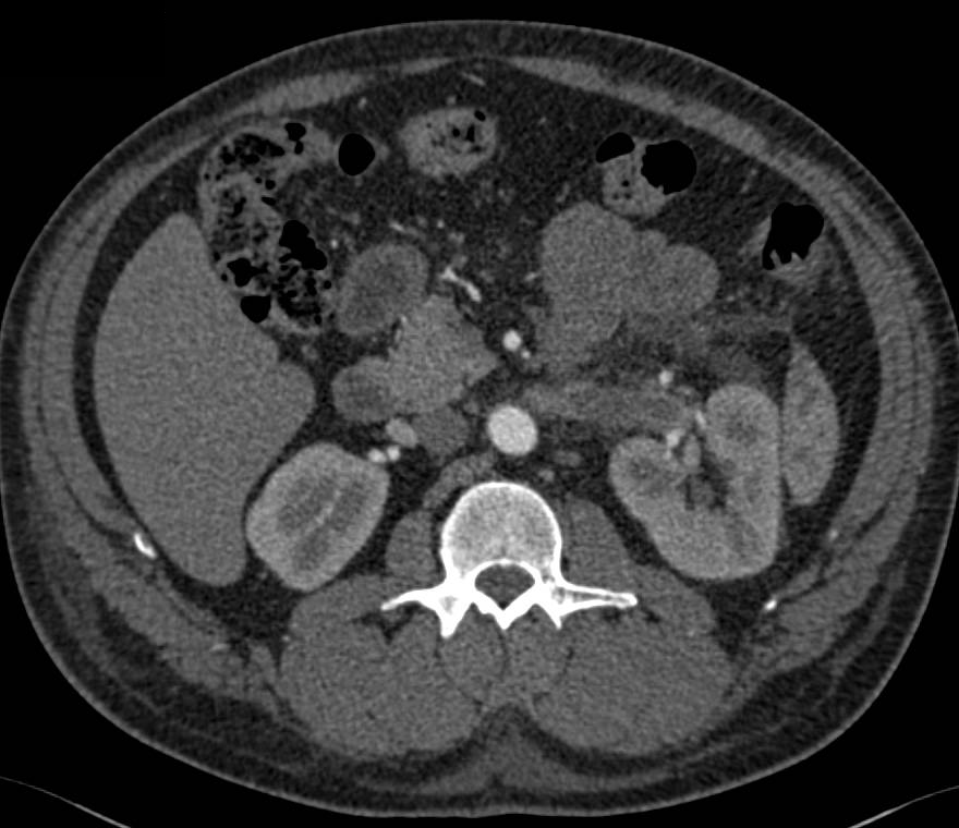 Renal Vein Thrombosis - CTisus CT Scan