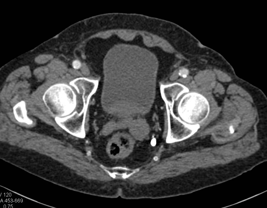 Enlarged Left Seminal Vesicle - CTisus CT Scan