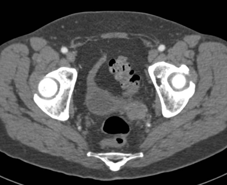 Bladder Cancer Involves the Left Ureter - CTisus CT Scan