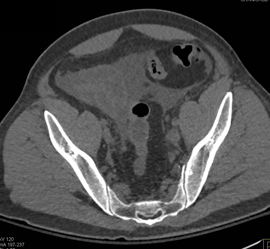 CT Cystogram with Leak s/p Laparoscopic Prostatectomy - Genitourinary ...
