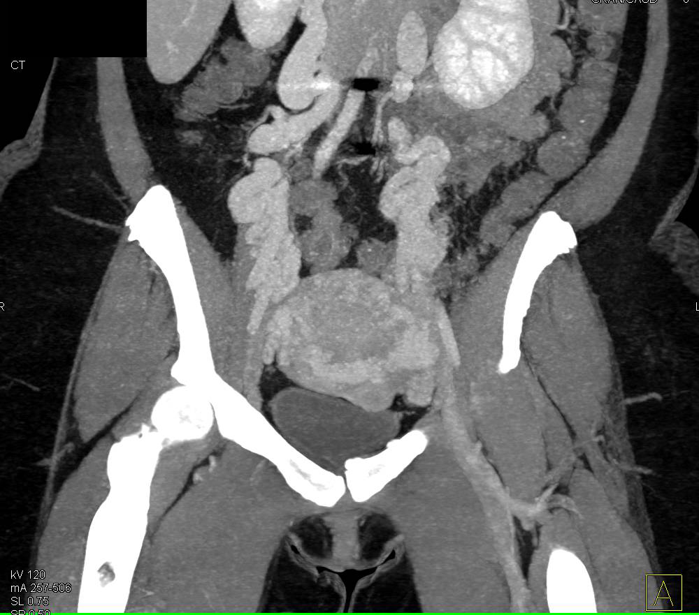 Pelvic Congestion Syndrome - CTisus CT Scan