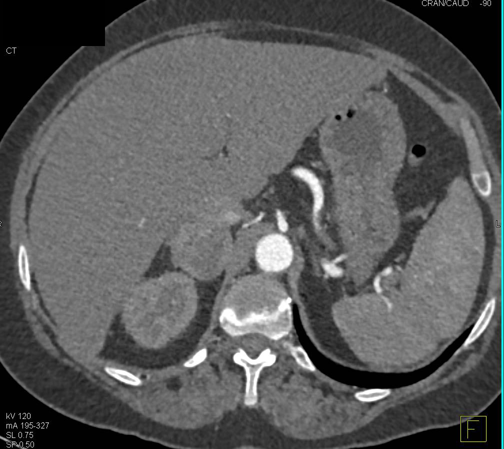 Pheochromocytoma Right Adrenal Gland - CTisus CT Scan