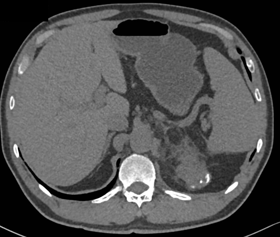 Germ Cell Tumor - CTisus CT Scan