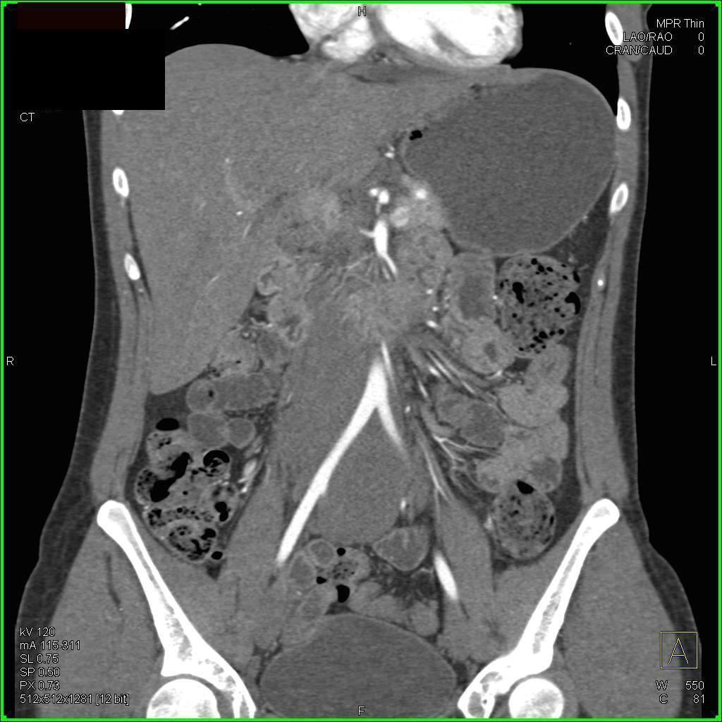 Unusual Appearance of Retroperitoneal Fibrosis Which Simulates a Neoplasm - CTisus CT Scan
