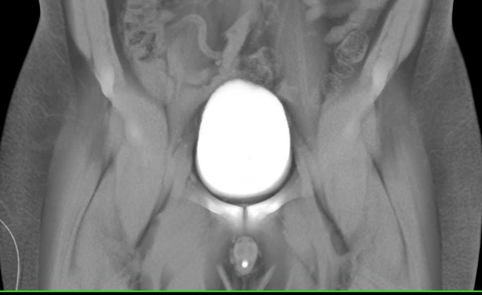 Normal CT Cystogram s/p Pelvic Trauma - CTisus CT Scan
