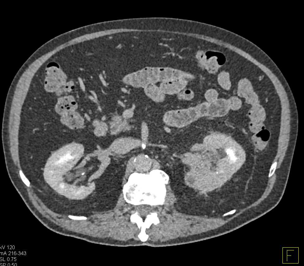 Left Renal Cell Carcinoma Invades the Left Renal Vein - CTisus CT Scan