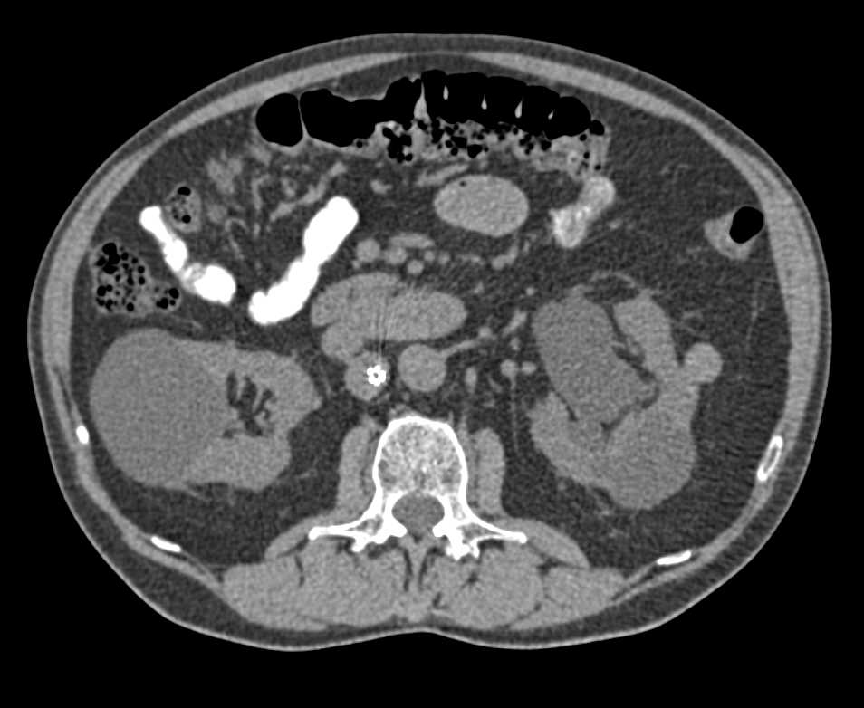 Bladder Cancer as the Cause for Hematuria - CTisus CT Scan