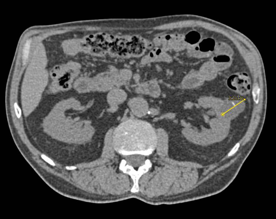 Bosniak 2 Cyst Left Kidney - CTisus CT Scan