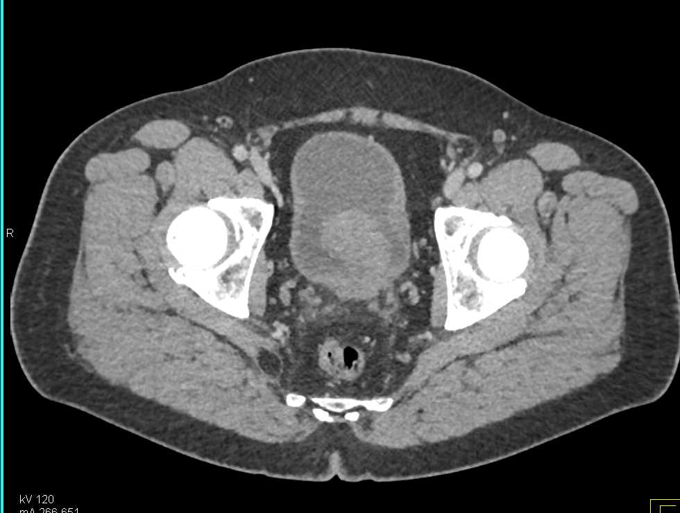 Prostate Cancer Invades Base of Bladder - CTisus CT Scan