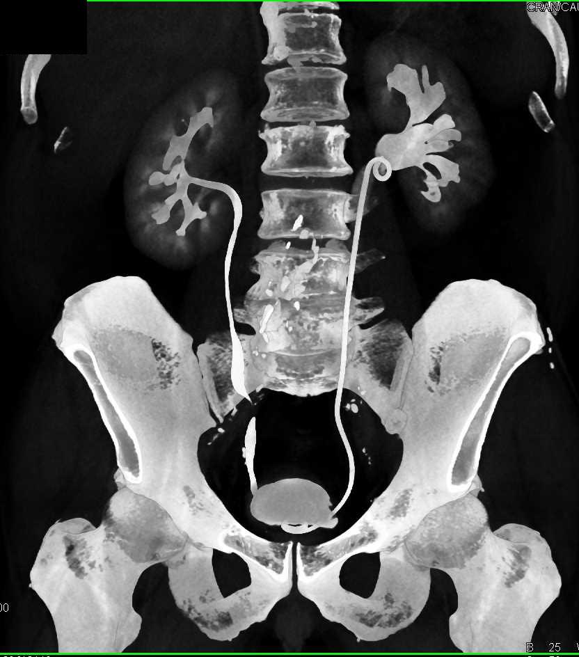 Transitional Cell Carcinoma Left Renal Pelvis and Distal Ureter - CTisus CT Scan