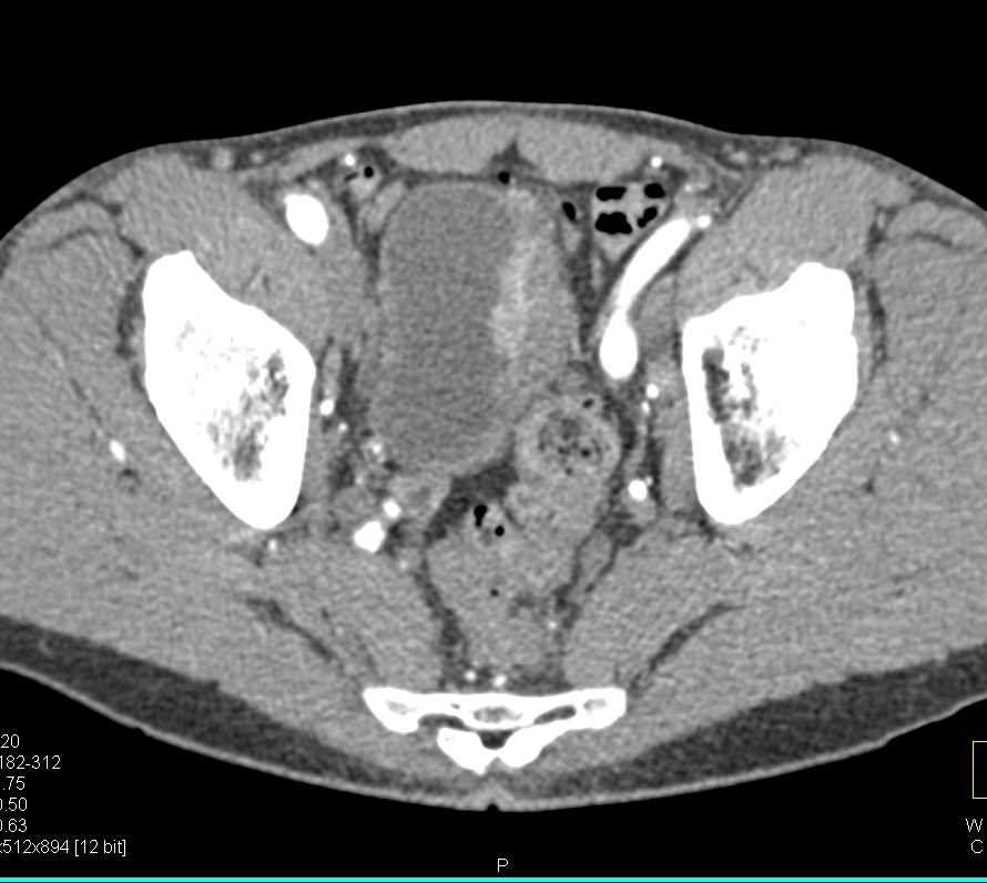 Infiltrating Bladder Cancer in Left Wall of Bladder - CTisus CT Scan