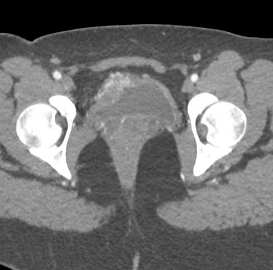 Enhancing Bladder Cancer - CTisus CT Scan
