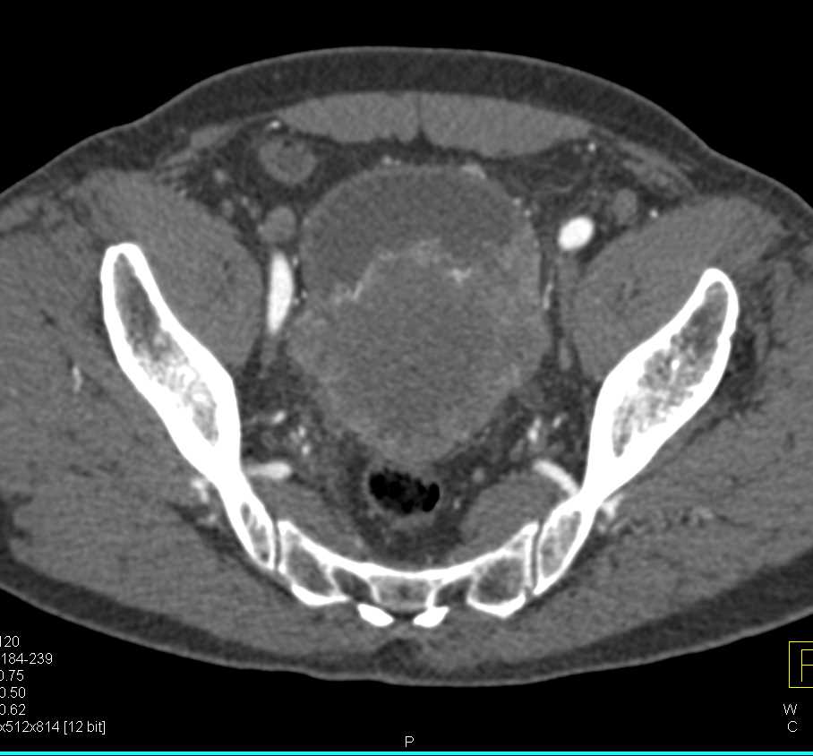 Large Bladder Stone and Chronic Cystitis - CTisus CT Scan