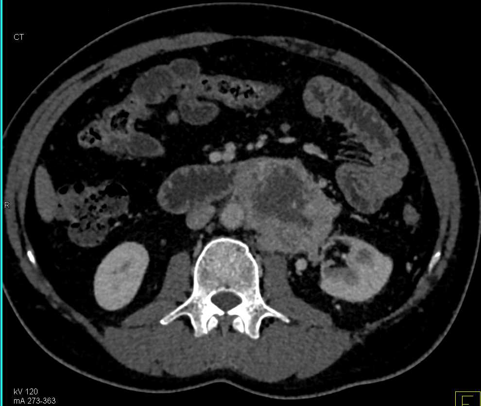 Paraganglioma - CTisus CT Scan