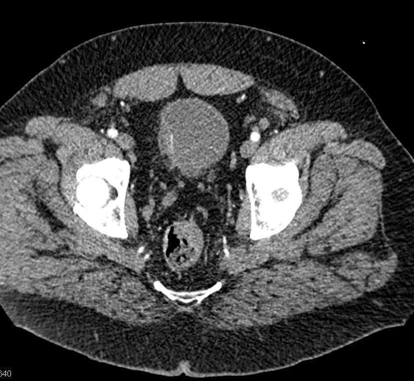 Incidental Bladder Cancer - CTisus CT Scan
