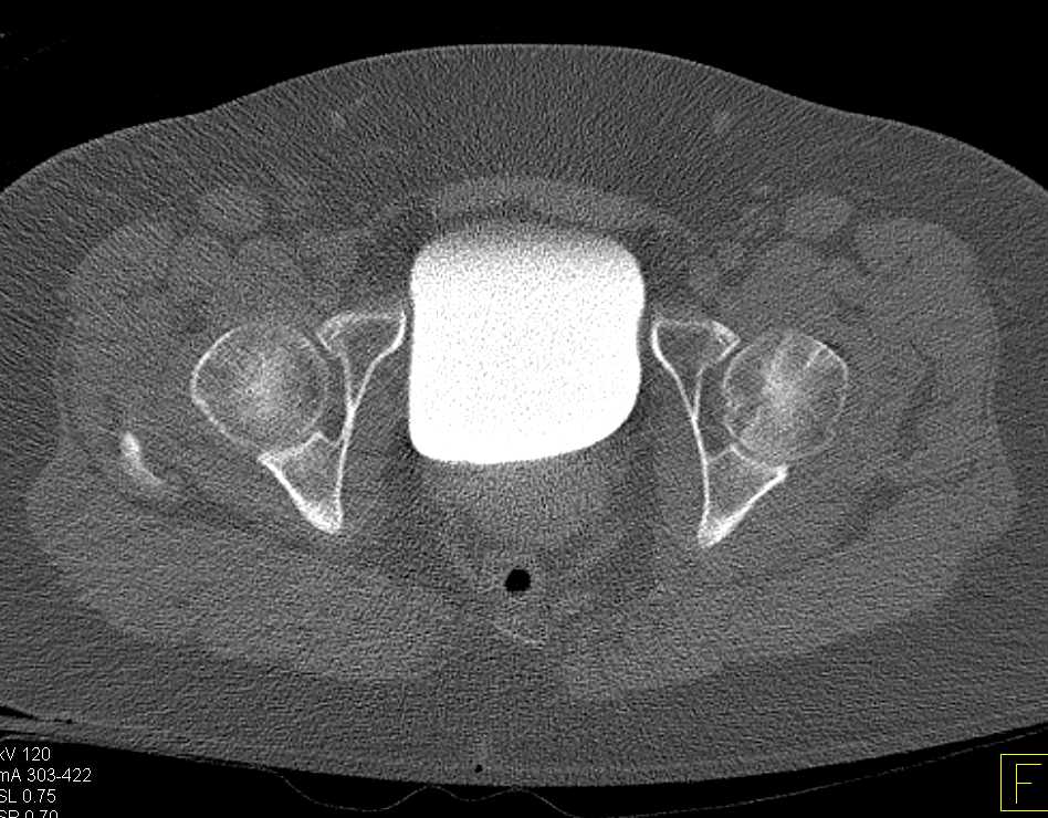Normal CT Cystogram s/p Trauma - CTisus CT Scan