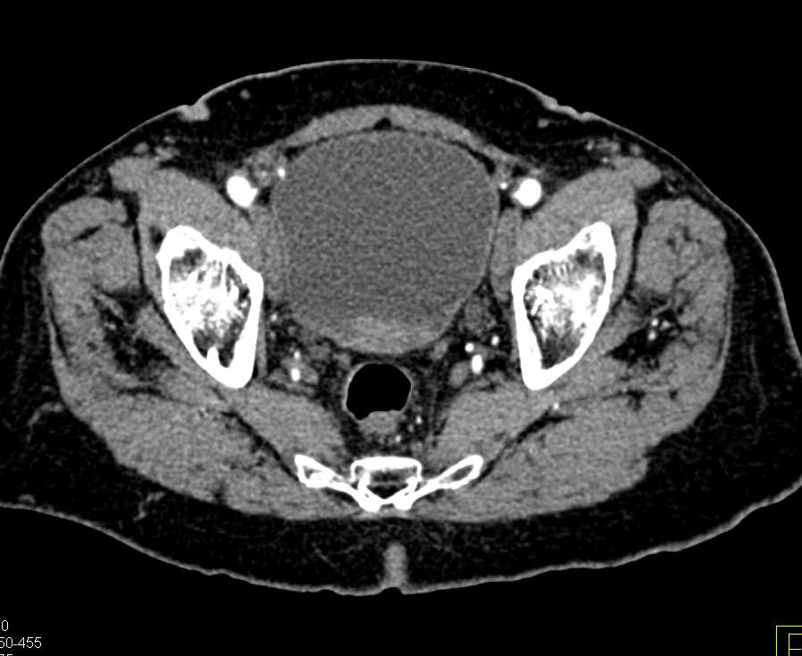 Blood Clots in the Bladder due to Subtle Bladder Cancer - CTisus CT Scan