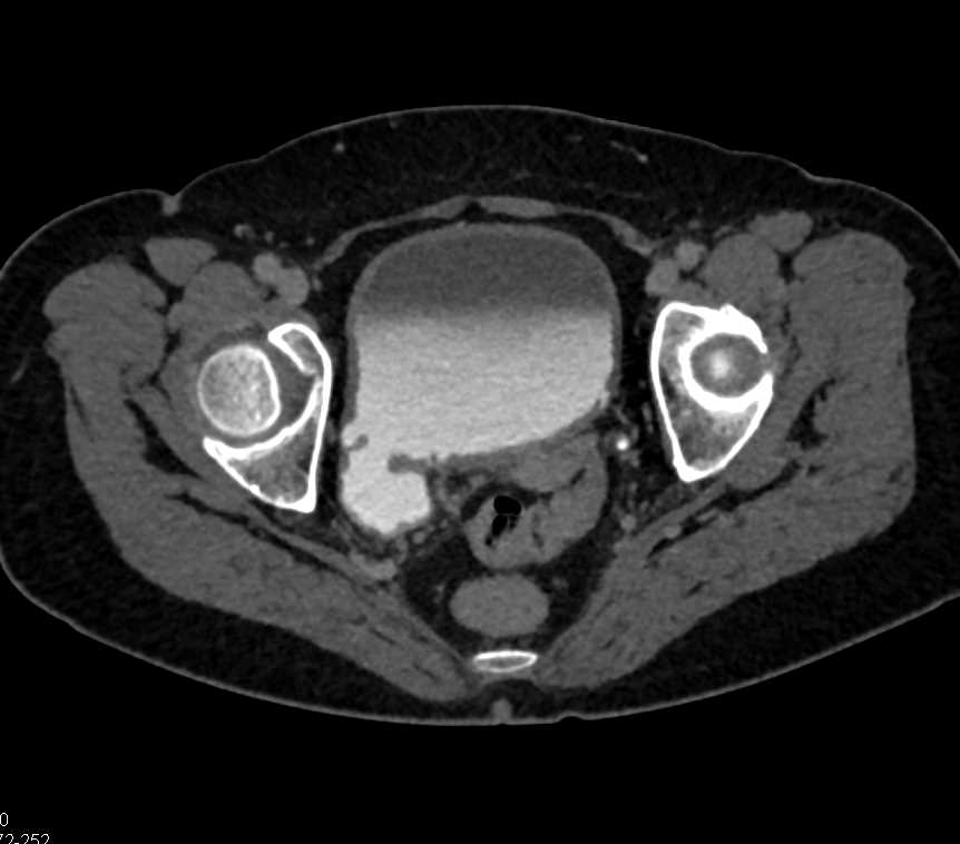 Bladder Diverticulum - CTisus CT Scan