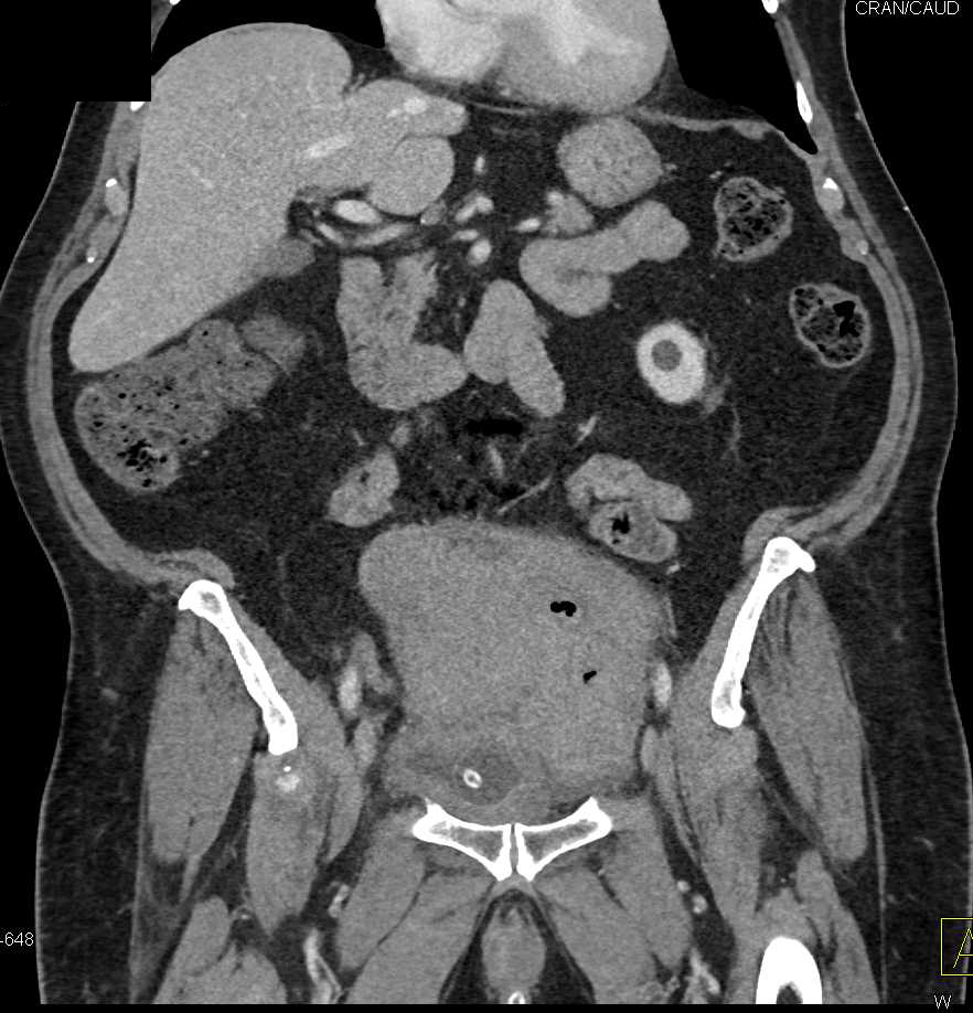 Pelvic Hematoma - CTisus CT Scan