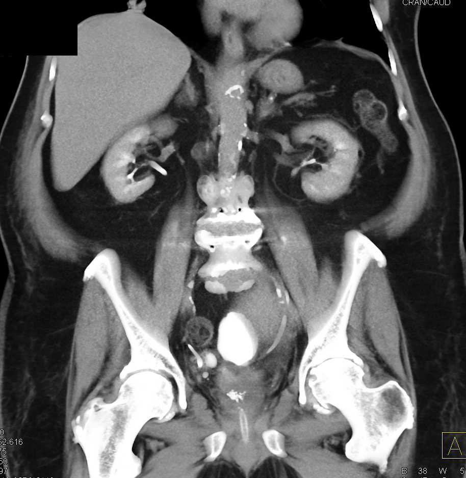 Pelvic Hematoma near the Bladder - CTisus CT Scan