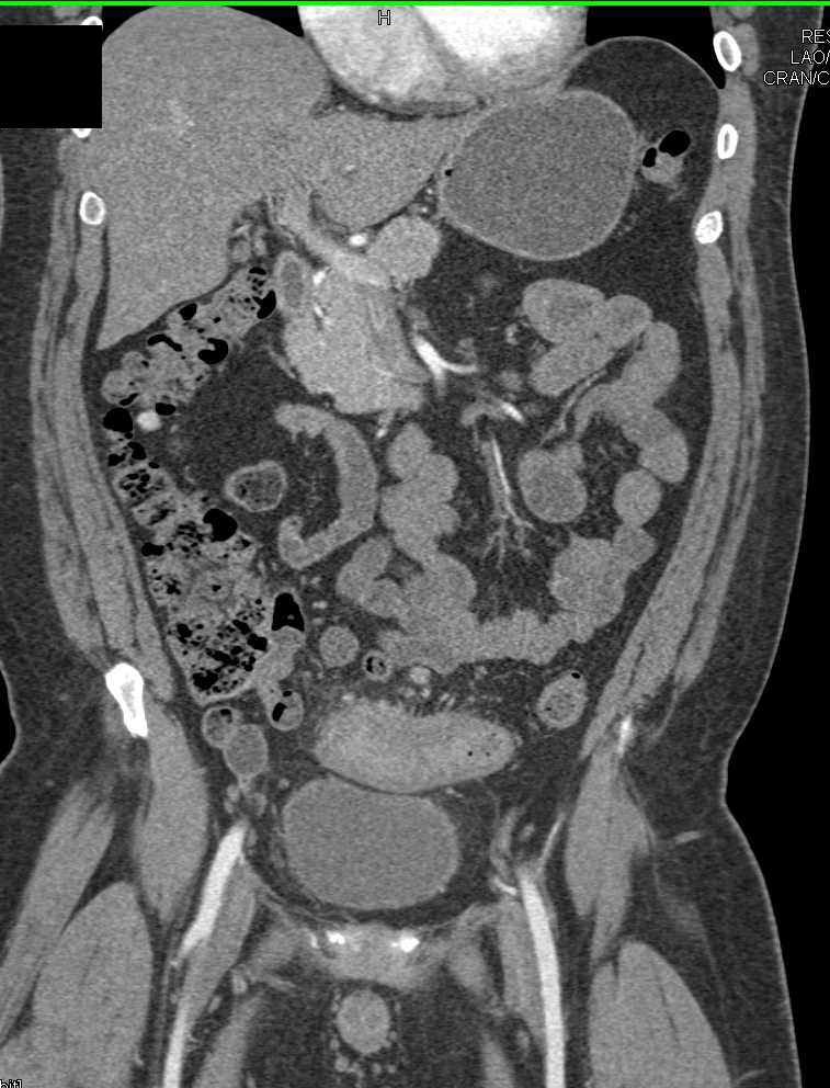 Diverticulitis with Fistulae to Bladder Best Seen on Sagittal Images - CTisus CT Scan