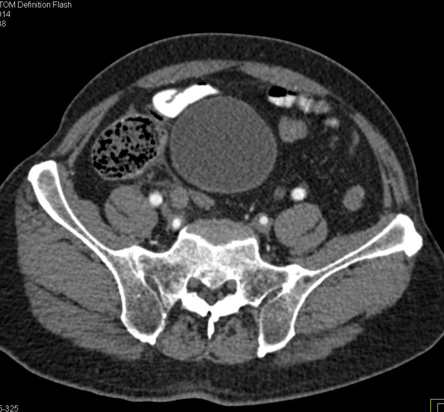 Obstructed Right Ureter by Tumor in the Distal Ureter - CTisus CT Scan