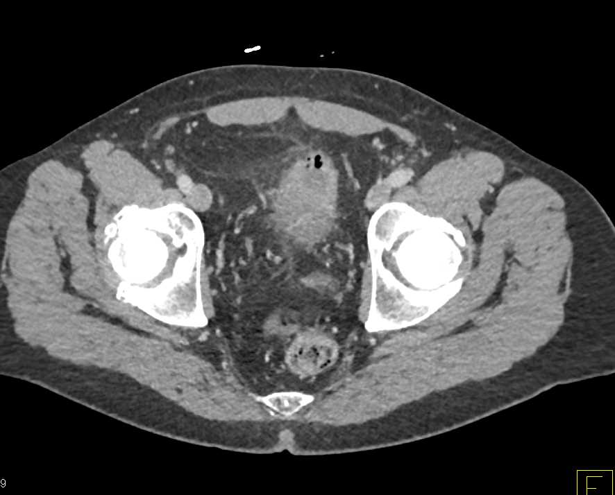 Diverticulitis with Fistulae to Dome of Bladder for Enterovesical Fistulae - CTisus CT Scan