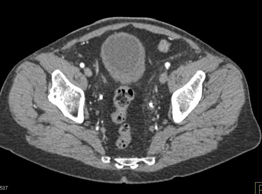 Bladder Cancer - CTisus CT Scan