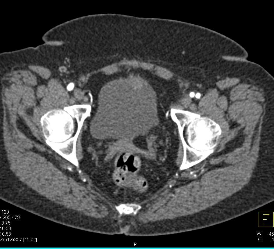 Bladder Cancer in the Anterior Dome of the Bladder - CTisus CT Scan