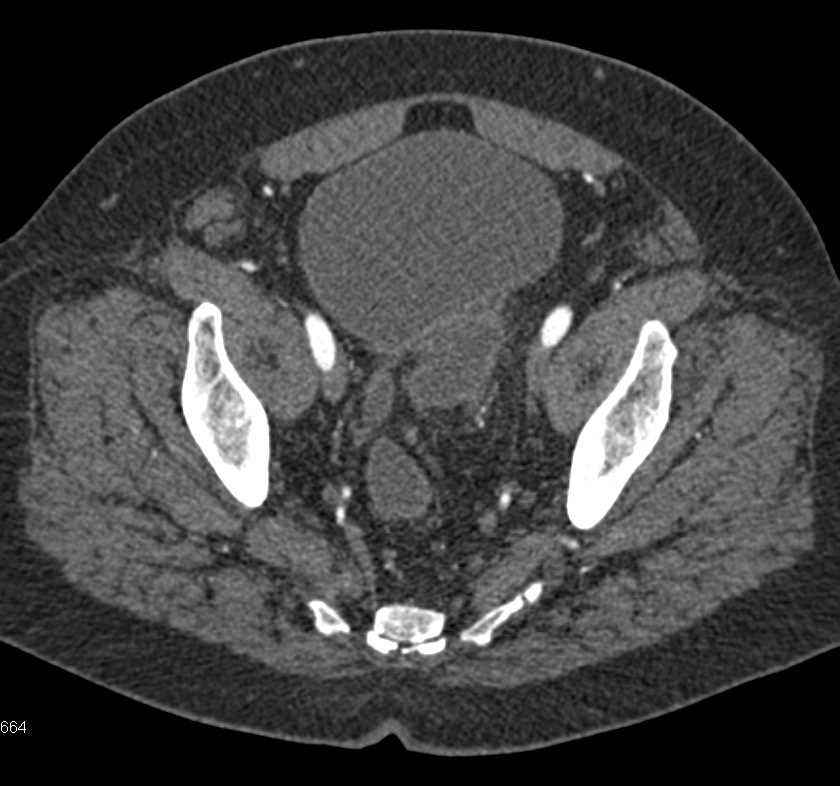 Carcinoma in Left Bladder Diverticulum - CTisus CT Scan