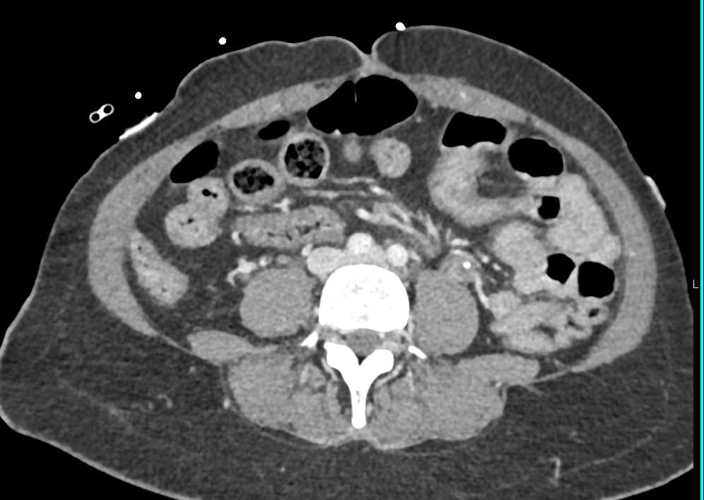 Clot in Left Gonadal Vein Which is Partially Thrombosed - CTisus CT Scan