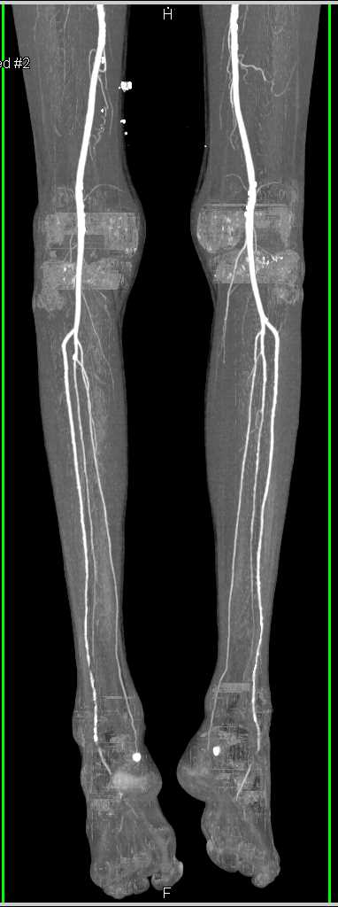 Subtle Bladder Cancer with Normal Runoff - CTisus CT Scan