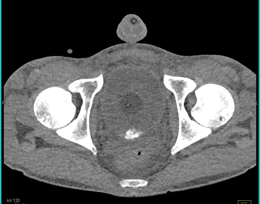 CT Cystogram with Leak and Multiple Clots in the Bladder and Fistulae to Abdominal Wall - CTisus CT Scan