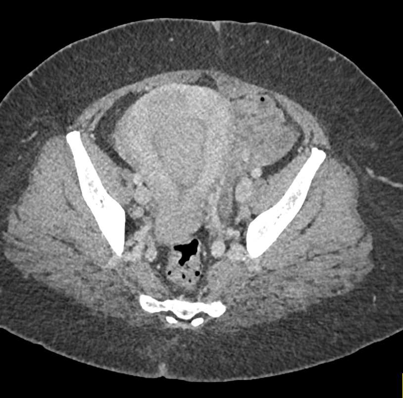Uterine Fibroids but no Ureter Obstruction - CTisus CT Scan