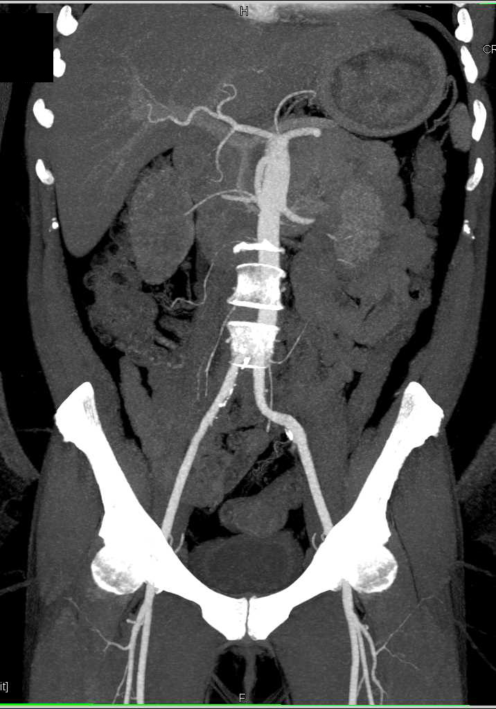 Retroperitoneal Fibrosis Encases Right Ureter and Inferior Vena Cava (IVC) - CTisus CT Scan