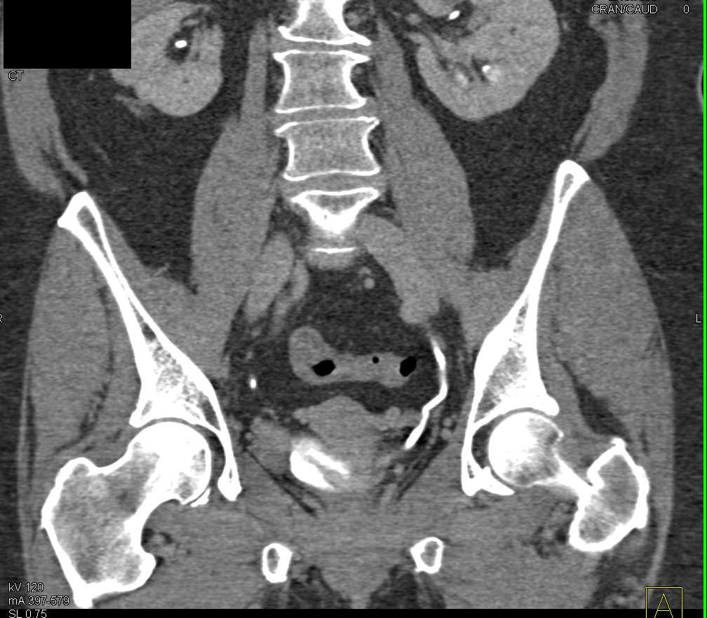 Bladder Cancer Near the Distal Right Ureterovesical Junction (UVJ) - CTisus CT Scan