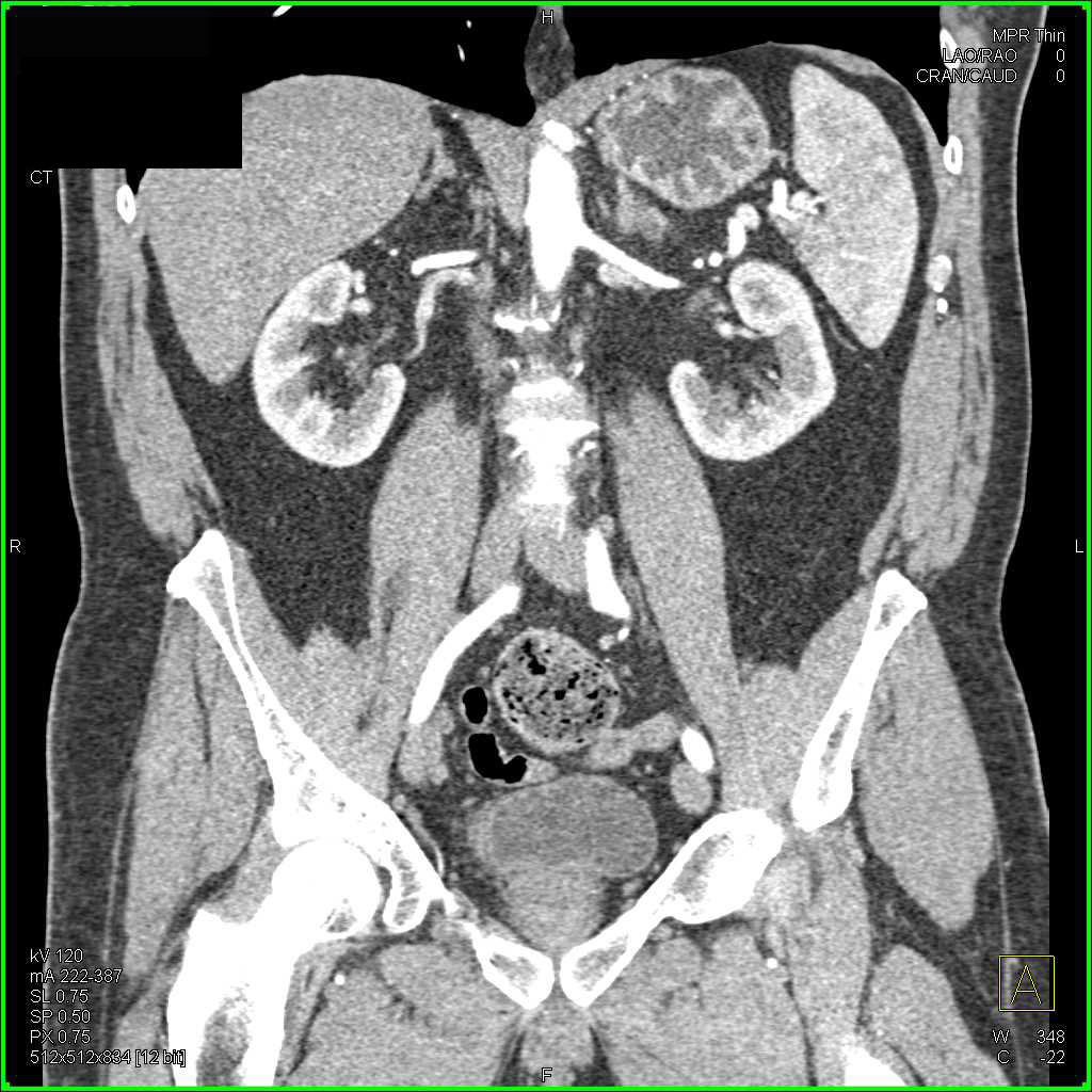 Fistulae from the Bladder to Rectal Space on CT Cystogram - CTisus CT Scan