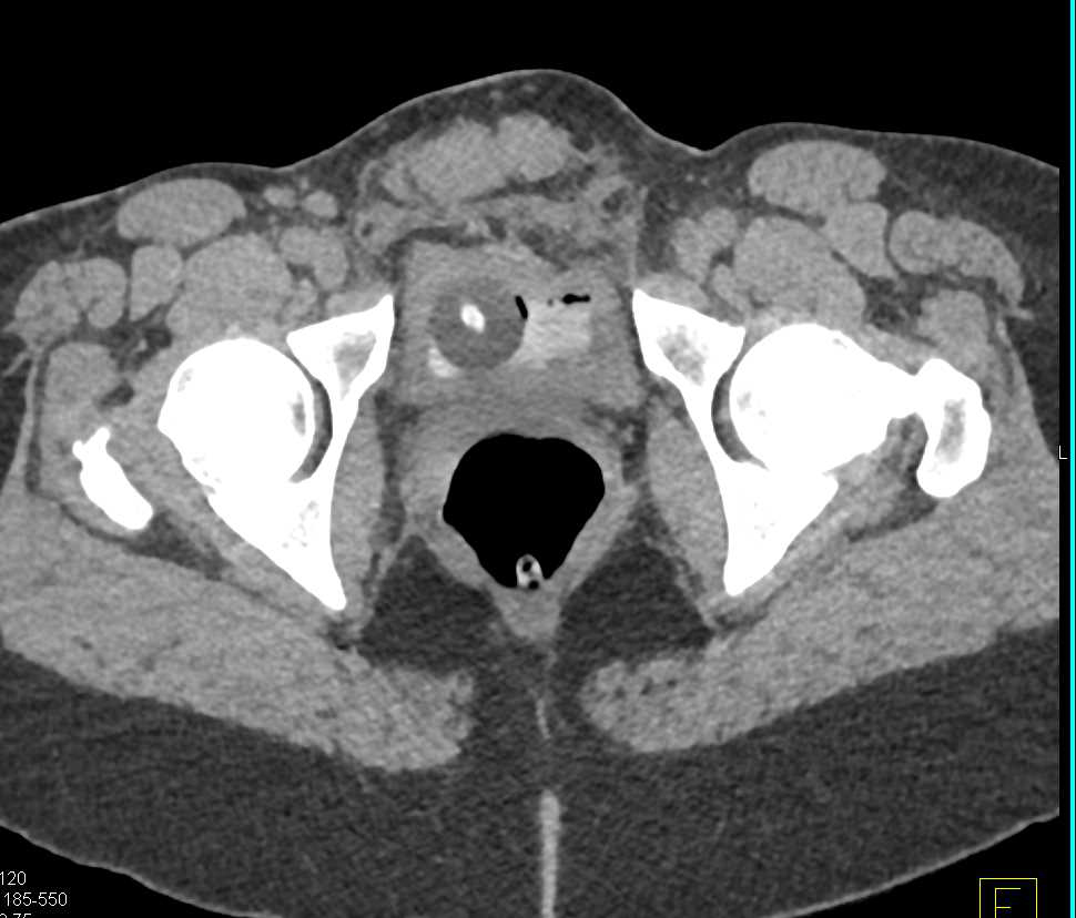 CT Cystogram with Contrast Extravasation from the Bladder - CTisus CT Scan