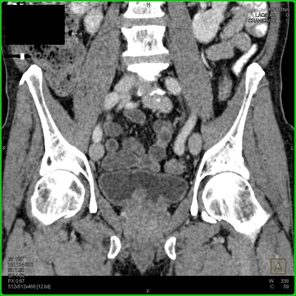 Prostate Cancer Pushing in to the Bladder - CTisus CT Scan
