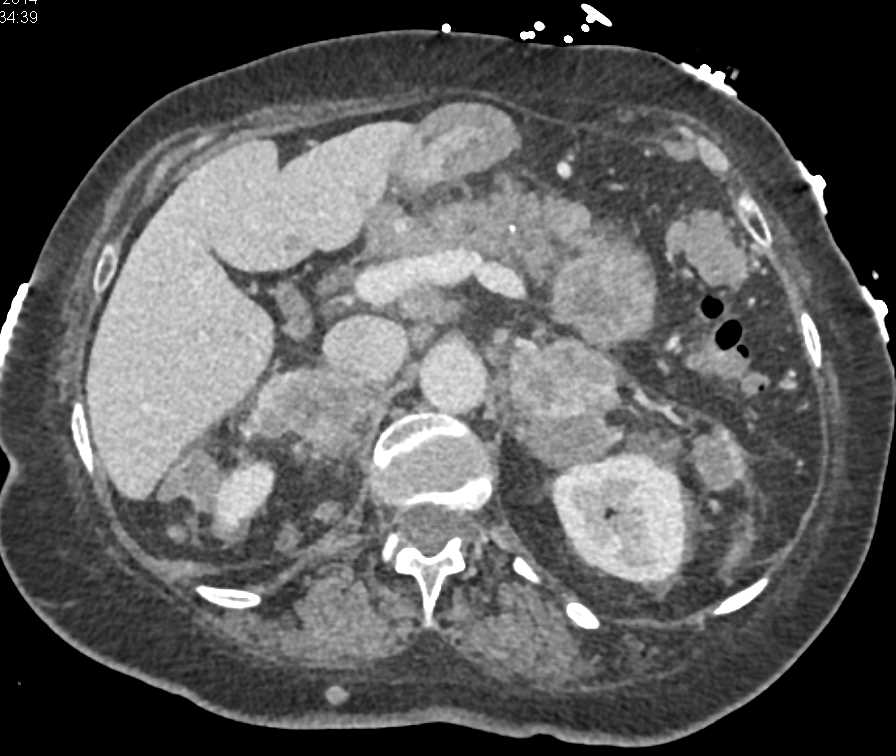 Metastatic Melanoma with Sites Including Adrenal Glands and Adenopathy - CTisus CT Scan