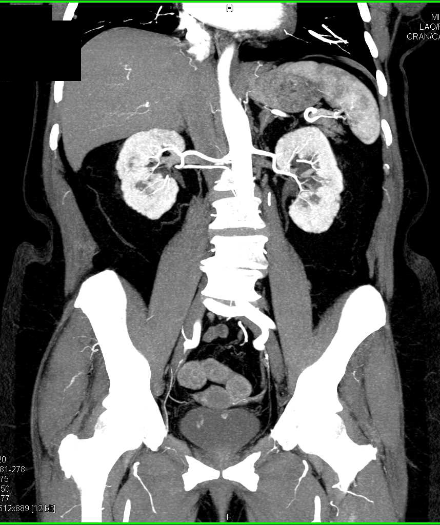 Subtle Enhancing 1cm Bladder Cancer - CTisus CT Scan