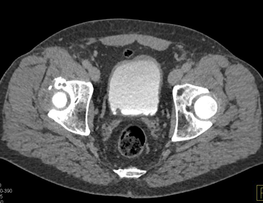 Incidental Bladder Cancer - CTisus CT Scan