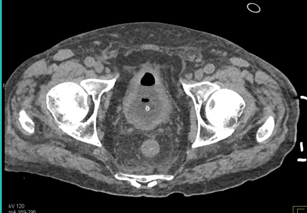 Bladder Diverticuli - CTisus CT Scan