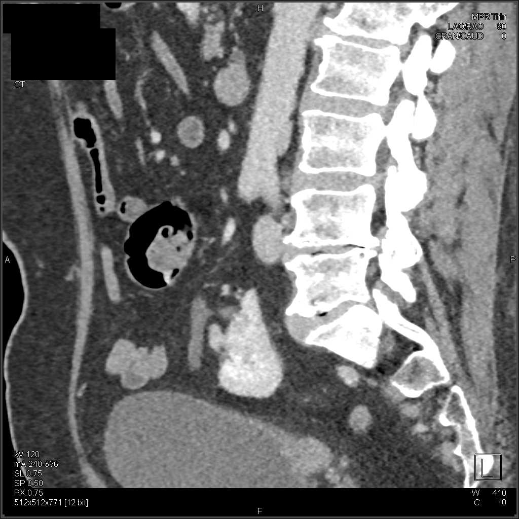 Recurrent Bladder Cancer - CTisus CT Scan
