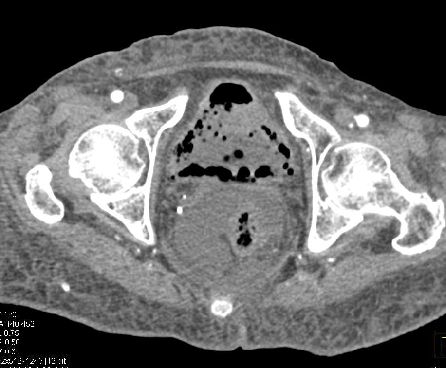 Emphysematous Cystitis - CTisus CT Scan
