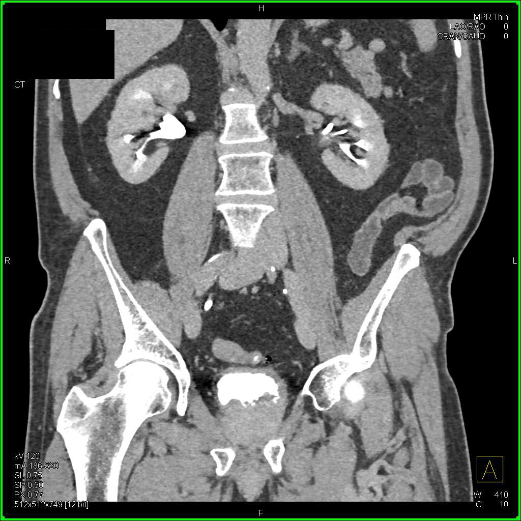 Bladder Cancer - CTisus CT Scan