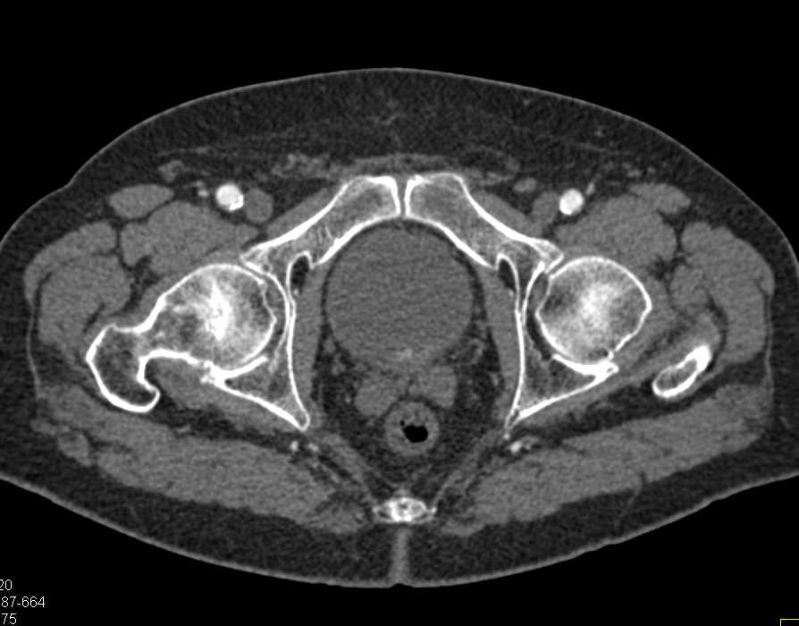 Incidental 1cm Bladder Cancer - CTisus CT Scan