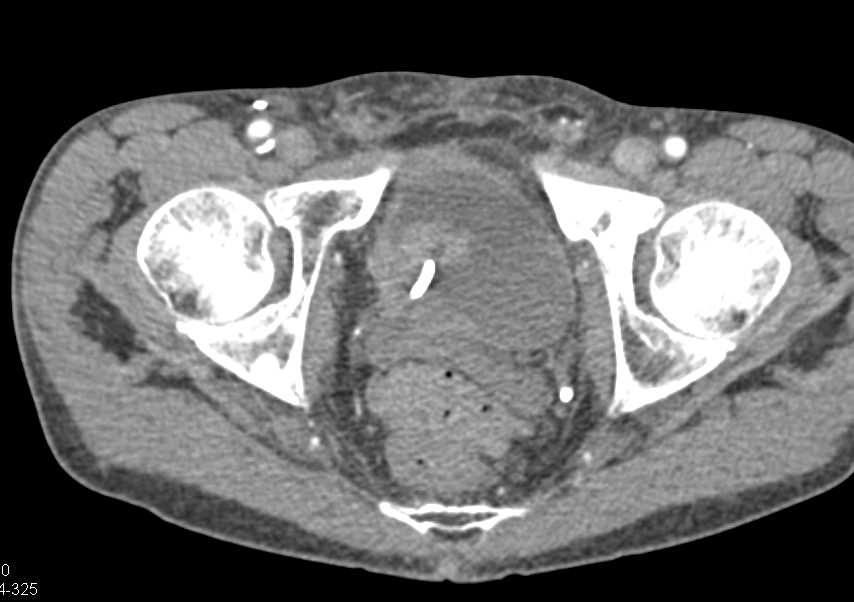 Bladder Cancer Near Right Ureterovesical Junction (UVJ) - CTisus CT Scan